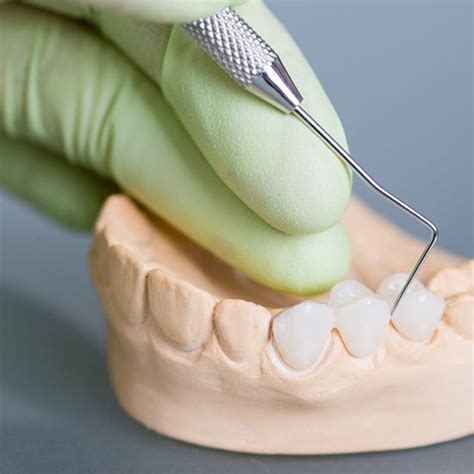 dental bridge arvada